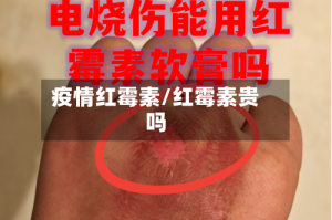 疫情红霉素/红霉素贵吗