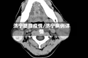 济宁腮腺疫情/济宁病例详情