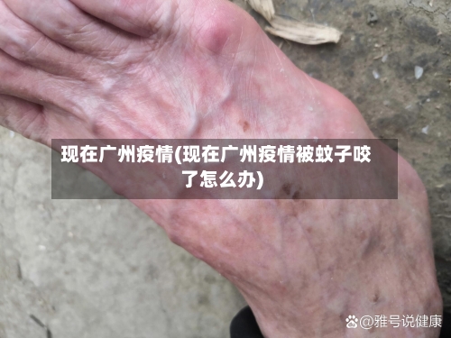 现在广州疫情(现在广州疫情被蚊子咬了怎么办)-第1张图片