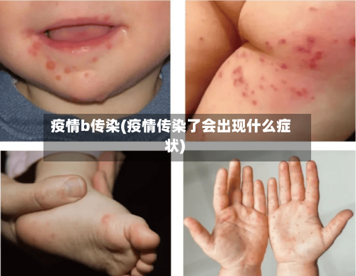 疫情b传染(疫情传染了会出现什么症状)-第2张图片