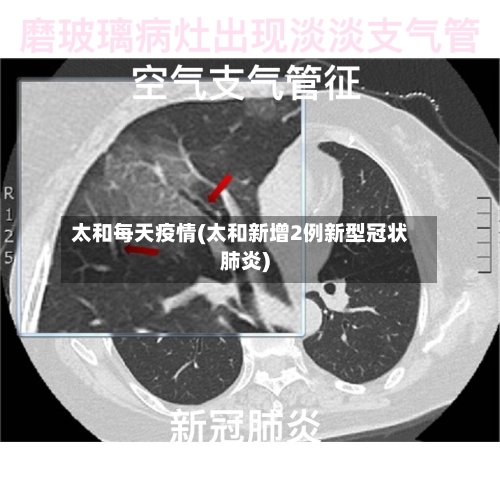 太和每天疫情(太和新增2例新型冠状肺炎)-第2张图片