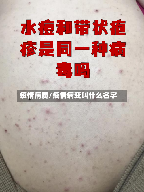 疫情病魔/疫情病变叫什么名字-第2张图片